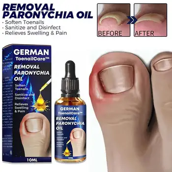 Лечение на гъбични нокти етерично масло, избелване на ръцете и краката, гел за ноктите от гъбички на пръстите на краката, инфекция, лак за краката, премахване на масла от ноктите